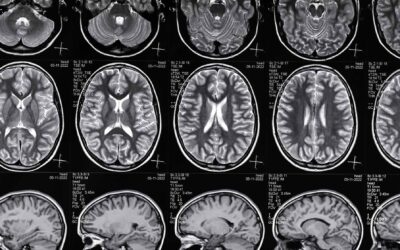 Brain Injury Personal Injury Claims: What You Should Know